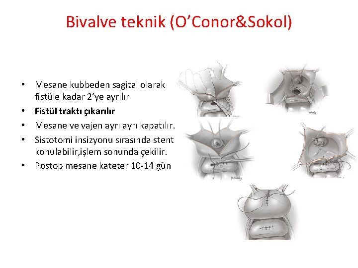 Bivalve teknik (O’Conor&Sokol) • Mesane kubbeden sagital olarak fistüle kadar 2’ye ayrılır • Fistül Bivalve teknik (O’Conor&Sokol) • Mesane kubbeden sagital olarak fistüle kadar 2’ye ayrılır • Fistül