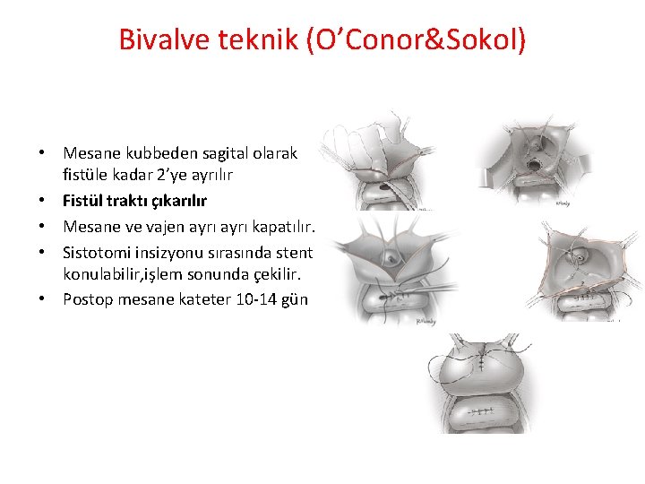 Bivalve teknik (O’Conor&Sokol) • Mesane kubbeden sagital olarak fistüle kadar 2’ye ayrılır • Fistül