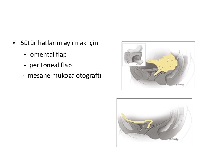  • Sütür hatlarını ayırmak için - omental flap - peritoneal flap - mesane