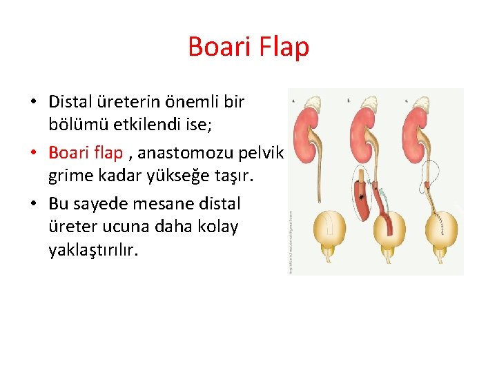 Boari Flap • Distal üreterin önemli bir bölümü etkilendi ise; • Boari flap ,