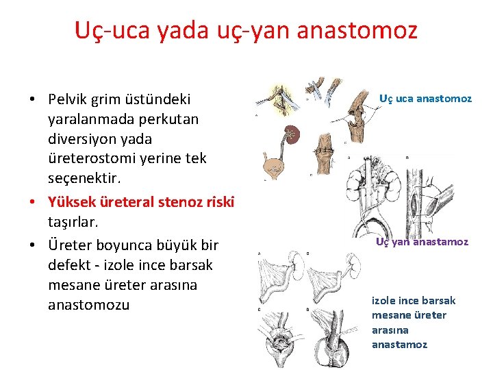 Uç-uca yada uç-yan anastomoz • Pelvik grim üstündeki yaralanmada perkutan diversiyon yada üreterostomi yerine