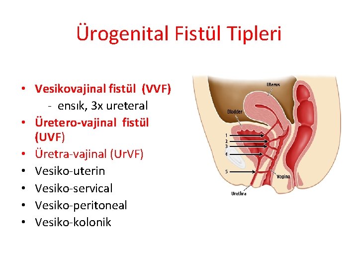 Ürogenital Fistül Tipleri • Vesikovajinal fistül (VVF) - ensık, 3 x ureteral • Üretero-vajinal