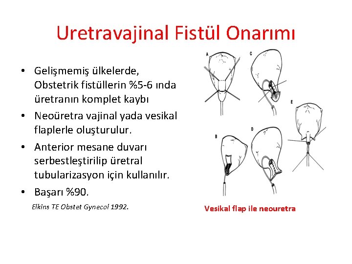 Uretravajinal Fistül Onarımı • Gelişmemiş ülkelerde, Obstetrik fistüllerin %5 -6 ında üretranın komplet kaybı