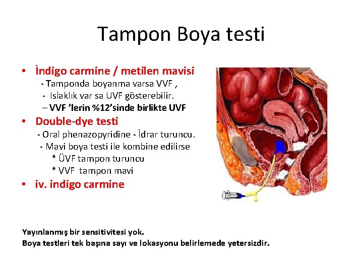 Tampon Boya testi • İndigo carmine / metilen mavisi - Tamponda boyanma varsa VVF Tampon Boya testi • İndigo carmine / metilen mavisi - Tamponda boyanma varsa VVF