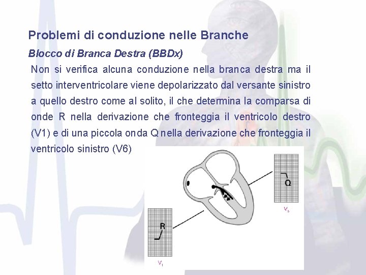 Problemi di conduzione nelle Branche Blocco di Branca Destra (BBDx) Non si verifica alcuna