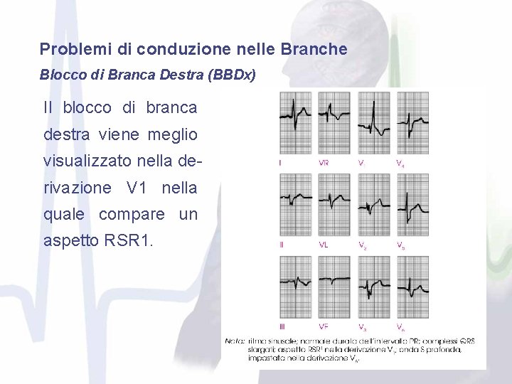 Problemi di conduzione nelle Branche Blocco di Branca Destra (BBDx) Il blocco di branca