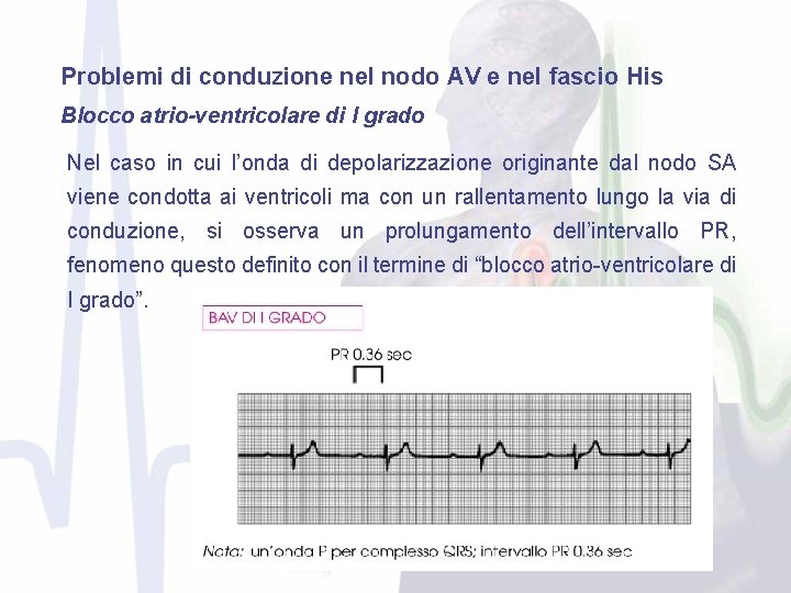 Problemi di conduzione nel nodo AV e nel fascio His Blocco atrio-ventricolare di I