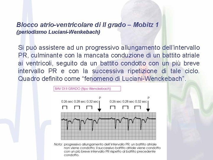 Blocco atrio-ventricolare di II grado – Mobitz 1 (periodismo Luciani-Wenkebach) Si può assistere ad