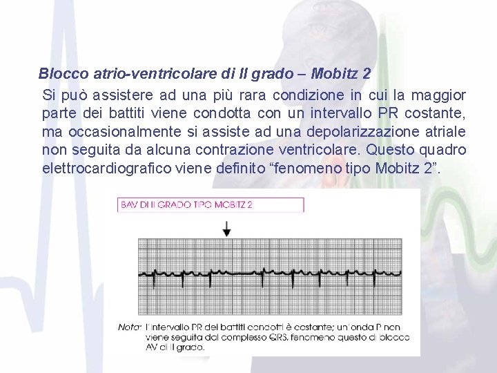 Blocco atrio-ventricolare di II grado – Mobitz 2 Si può assistere ad una più