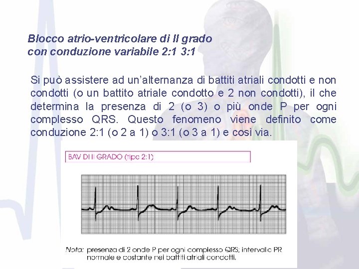 Blocco atrio-ventricolare di II grado conduzione variabile 2: 1 3: 1 Si può assistere
