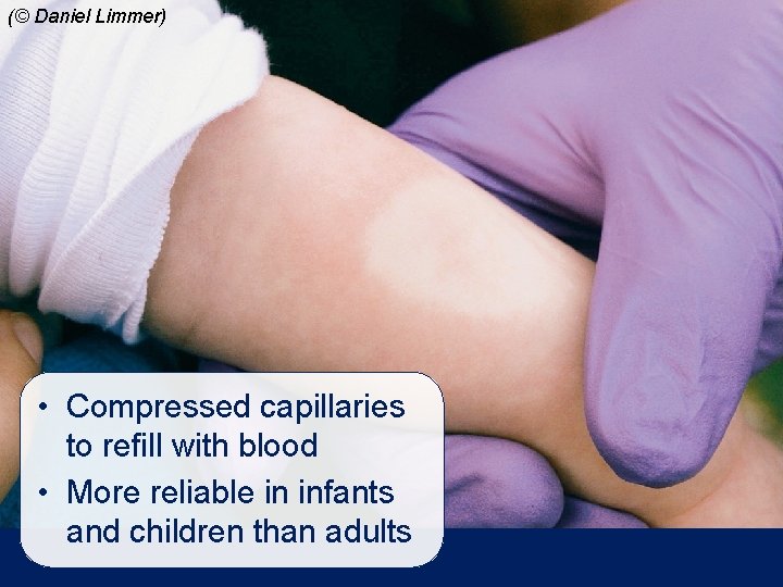 (© Daniel Limmer) • Compressed capillaries to refill with blood • More reliable in (© Daniel Limmer) • Compressed capillaries to refill with blood • More reliable in