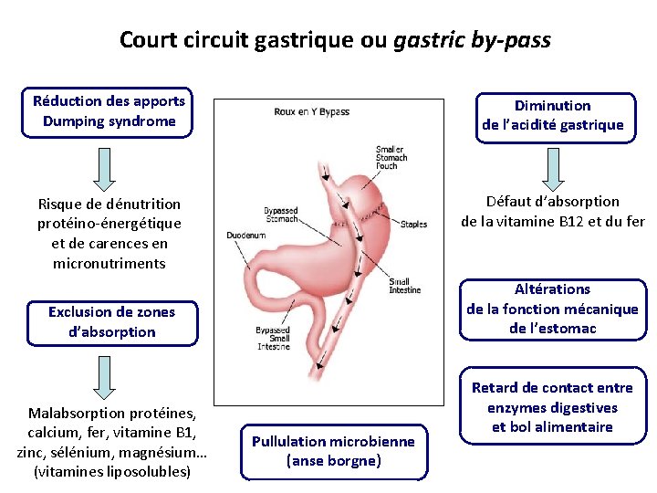 Court circuit gastrique ou gastric by-pass Réduction des apports Dumping syndrome Diminution de l’acidité