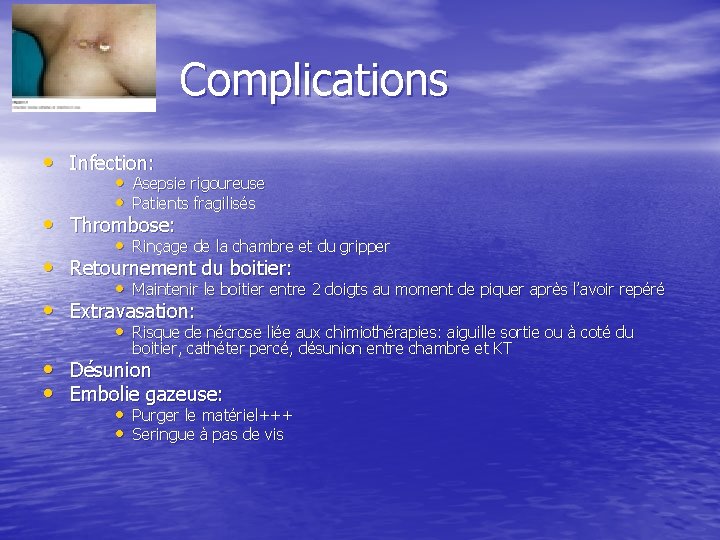 Complications • Infection: • • Asepsie rigoureuse • Patients fragilisés Thrombose: • Rinçage de