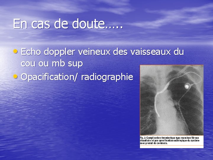 En cas de doute…. . • Echo doppler veineux des vaisseaux du cou ou