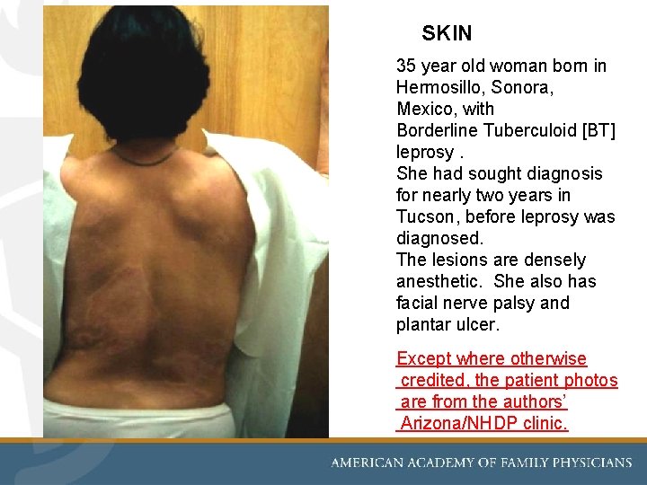 SKIN 35 year old woman born in Hermosillo, Sonora, Mexico, with Borderline Tuberculoid [BT]