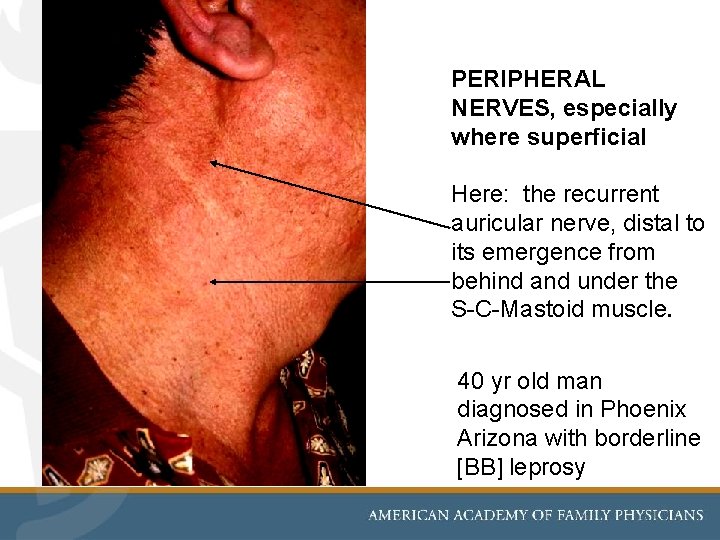 PERIPHERAL NERVES, especially where superficial Here: the recurrent auricular nerve, distal to its emergence