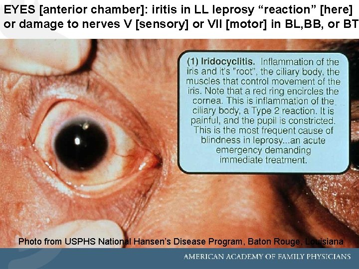 EYES [anterior chamber]: iritis in LL leprosy “reaction” [here] or damage to nerves V
