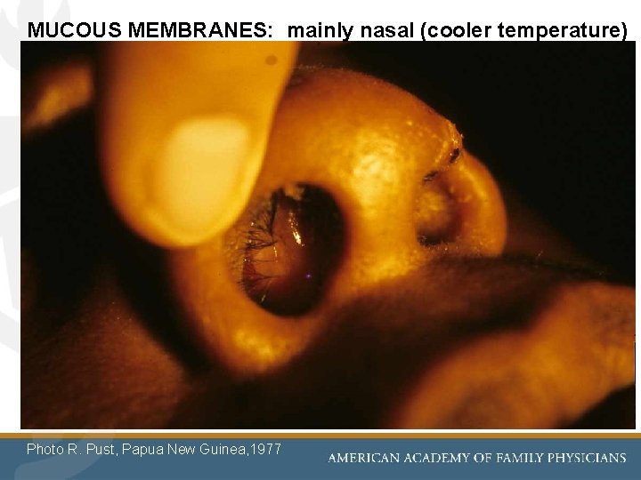 MUCOUS MEMBRANES: mainly nasal (cooler temperature) Photo R. Pust, Papua New Guinea, 1977 