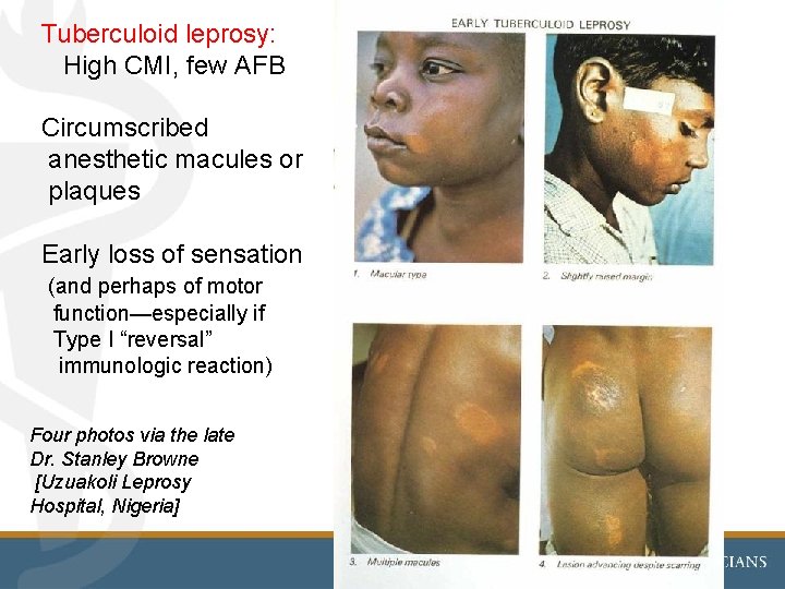 Tuberculoid leprosy: High CMI, few AFB Circumscribed anesthetic macules or plaques Early loss of