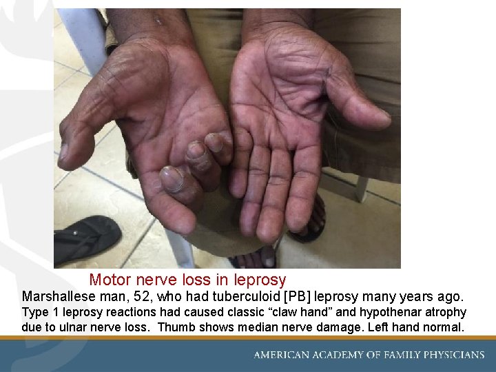  Motor nerve loss in leprosy Marshallese man, 52, who had tuberculoid [PB] leprosy