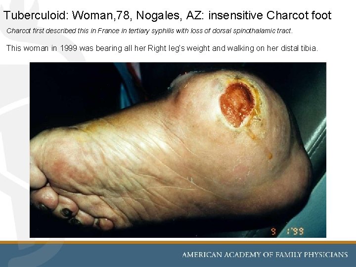 Tuberculoid: Woman, 78, Nogales, AZ: insensitive Charcot foot Charcot first described this in France
