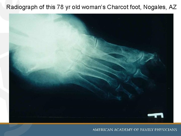 Radiograph of this 78 yr old woman’s Charcot foot, Nogales, AZ 