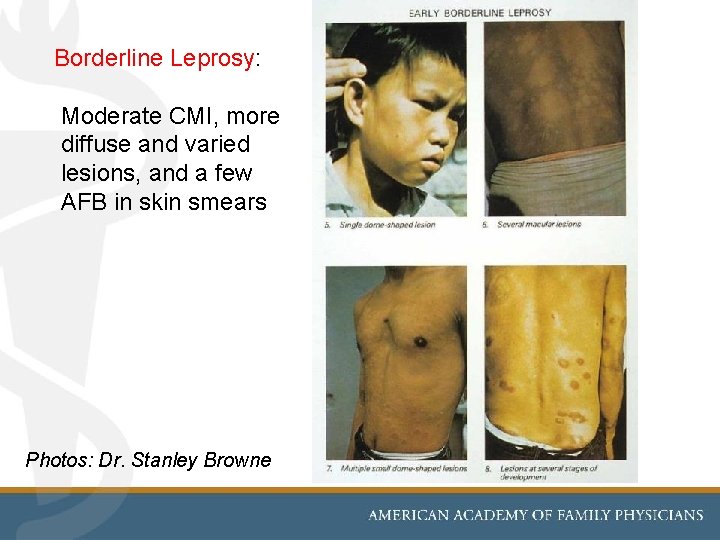 Borderline Leprosy: Moderate CMI, more diffuse and varied lesions, and a few AFB in