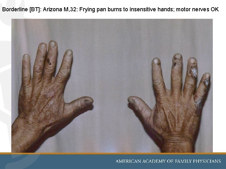 Borderline [BT]: Arizona M, 32: Frying pan burns to insensitive hands; motor nerves OK