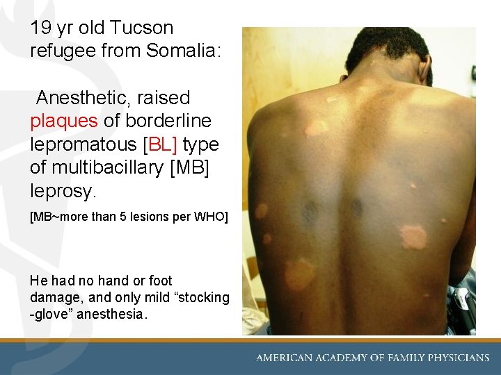 19 yr old Tucson refugee from Somalia: Anesthetic, raised plaques of borderline lepromatous [BL]