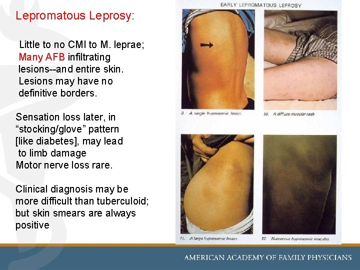 Lepromatous Leprosy: Little to no CMI to M. leprae; Many AFB infiltrating lesions--and entire