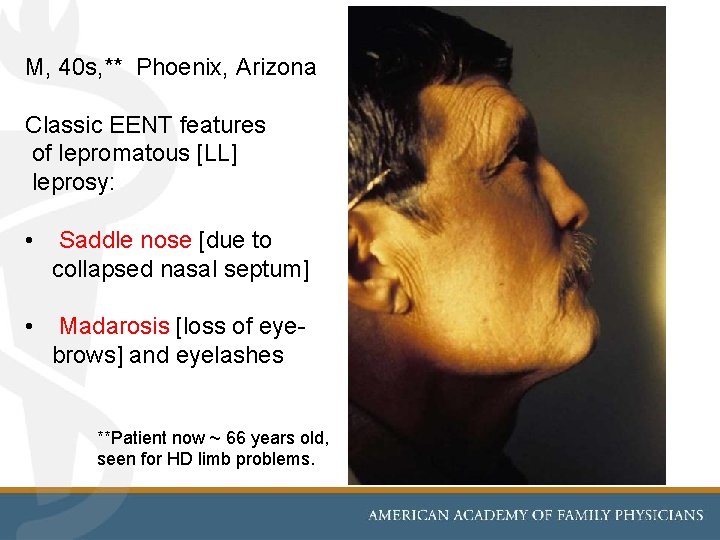 M, 40 s, ** Phoenix, Arizona Classic EENT features of lepromatous [LL] leprosy: •