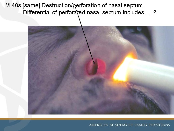  M, 40 s [same] Destruction/perforation of nasal septum. Differential of perforated nasal septum