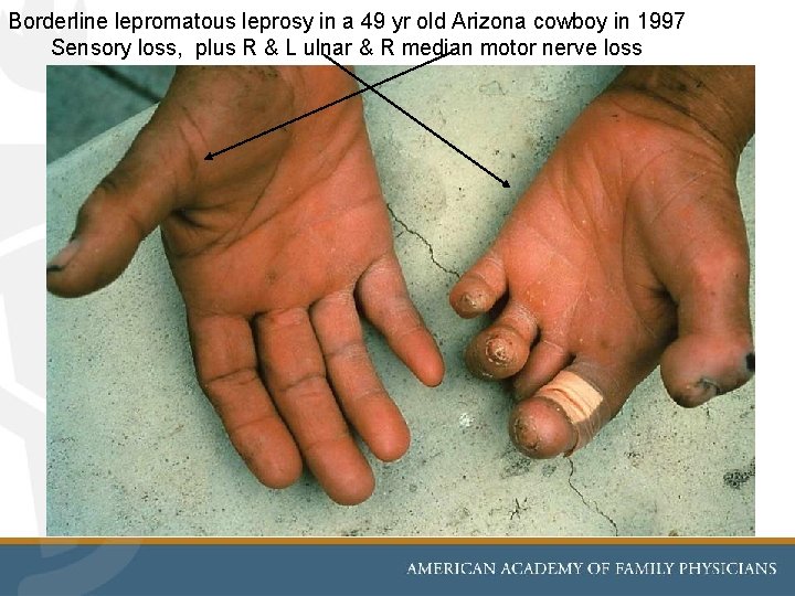 Borderline lepromatous leprosy in a 49 yr old Arizona cowboy in 1997 Sensory loss,