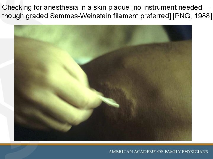 Checking for anesthesia in a skin plaque [no instrument needed— though graded Semmes-Weinstein filament