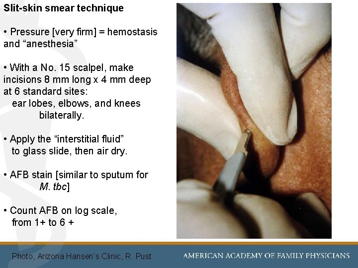 Slit-skin smear technique • Pressure [very firm] = hemostasis and “anesthesia” • With a