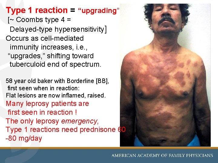 Type 1 reaction = “upgrading” [~ Coombs type 4 = Delayed-type hypersensitivity] Occurs as