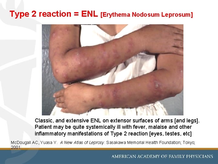 Type 2 reaction = ENL [Erythema Nodosum Leprosum] Classic, and extensive ENL on extensor