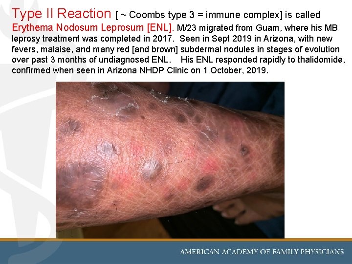 Type II Reaction [ ~ Coombs type 3 = immune complex] is called Erythema