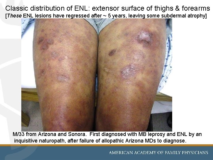 Classic distribution of ENL: extensor surface of thighs & forearms [These ENL lesions have