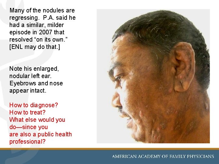 Many of the nodules are regressing. P. A. said he had a similar, milder