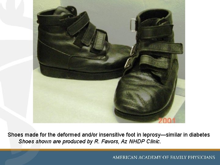 Shoes made for the deformed and/or insensitive foot in leprosy—similar in diabetes Shoes shown