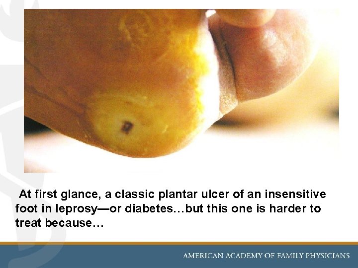 At first glance, a classic plantar ulcer of an insensitive foot in leprosy—or diabetes…but