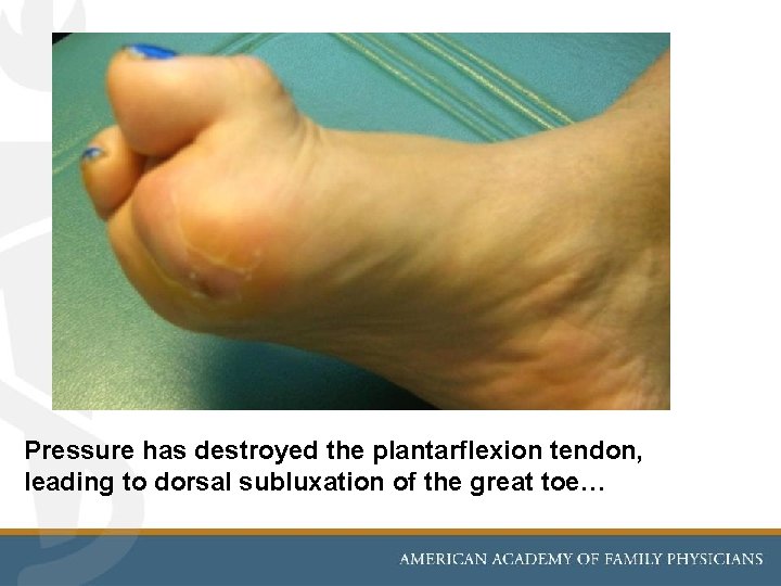 Pressure has destroyed the plantarflexion tendon, leading to dorsal subluxation of the great toe…