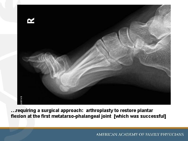 …requiring a surgical approach: arthroplasty to restore plantar flexion at the first metatarso-phalangeal joint