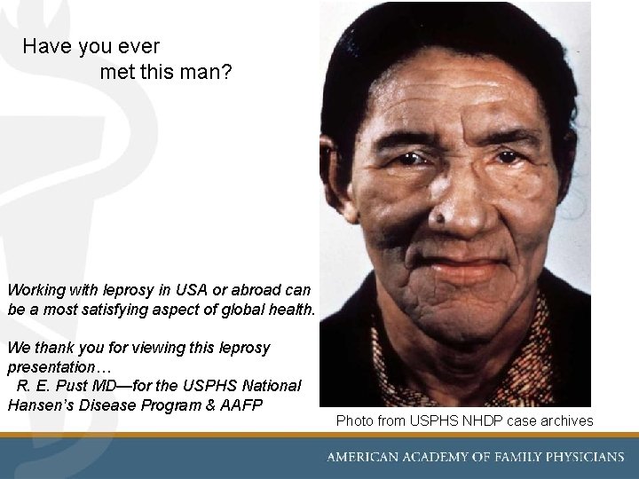 Have you ever met this man? Working with leprosy in USA or abroad can