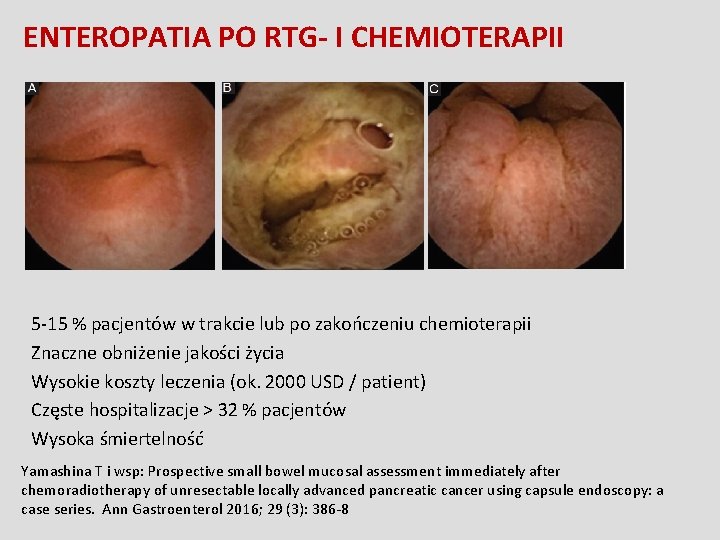 ENTEROPATIA PO RTG- I CHEMIOTERAPII 5 -15 % pacjentów w trakcie lub po zakończeniu