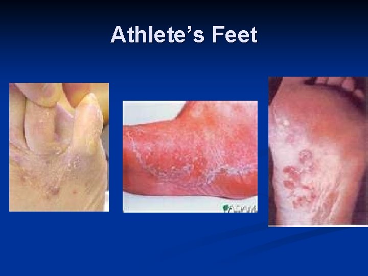 Athlete’s Feet 