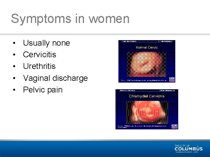 Symptoms in women • • • Usually none Cervicitis Urethritis Vaginal discharge Pelvic pain