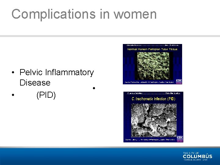 Complications in women • Pelvic Inflammatory Disease • • (PID) 