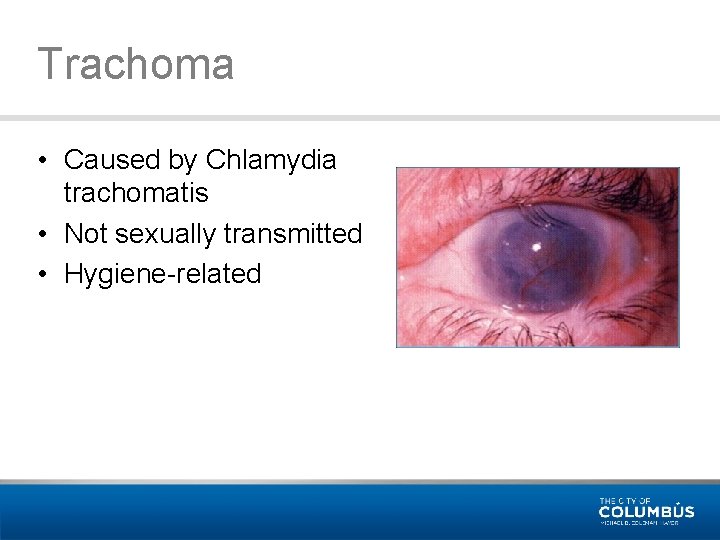 Trachoma • Caused by Chlamydia trachomatis • Not sexually transmitted • Hygiene-related 